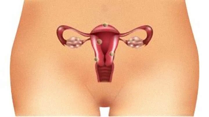 Miomas no utero