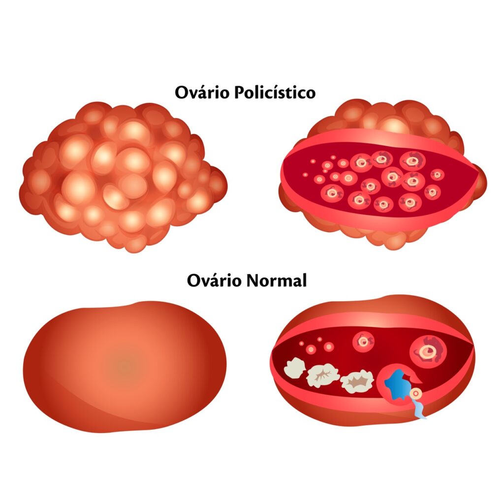 Quero um Bebê - SINTOMAS DE INFLAMAÇÃO NOS OVÁRIOS: A