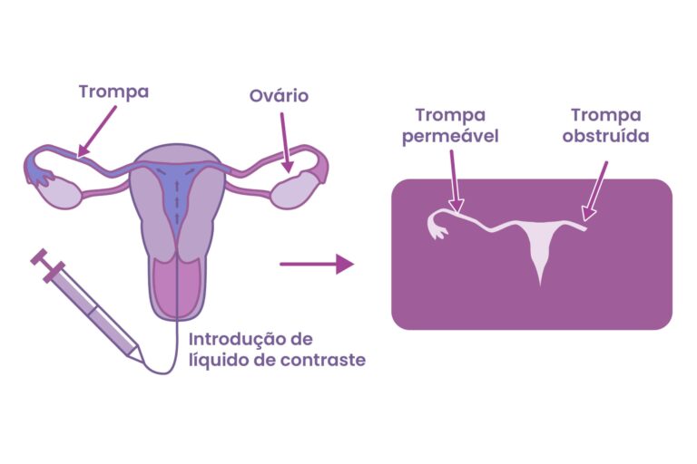 Histerossalpingografia: exame da fertilidade que vê as trompas uterinas ...