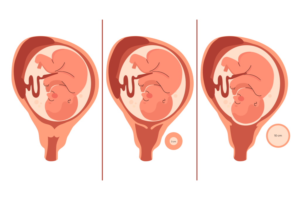 A dilatação vaginal no momento do parto