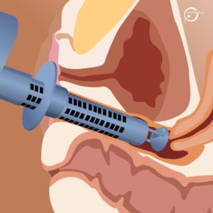 Laser Vaginal: o tratamento da região íntima